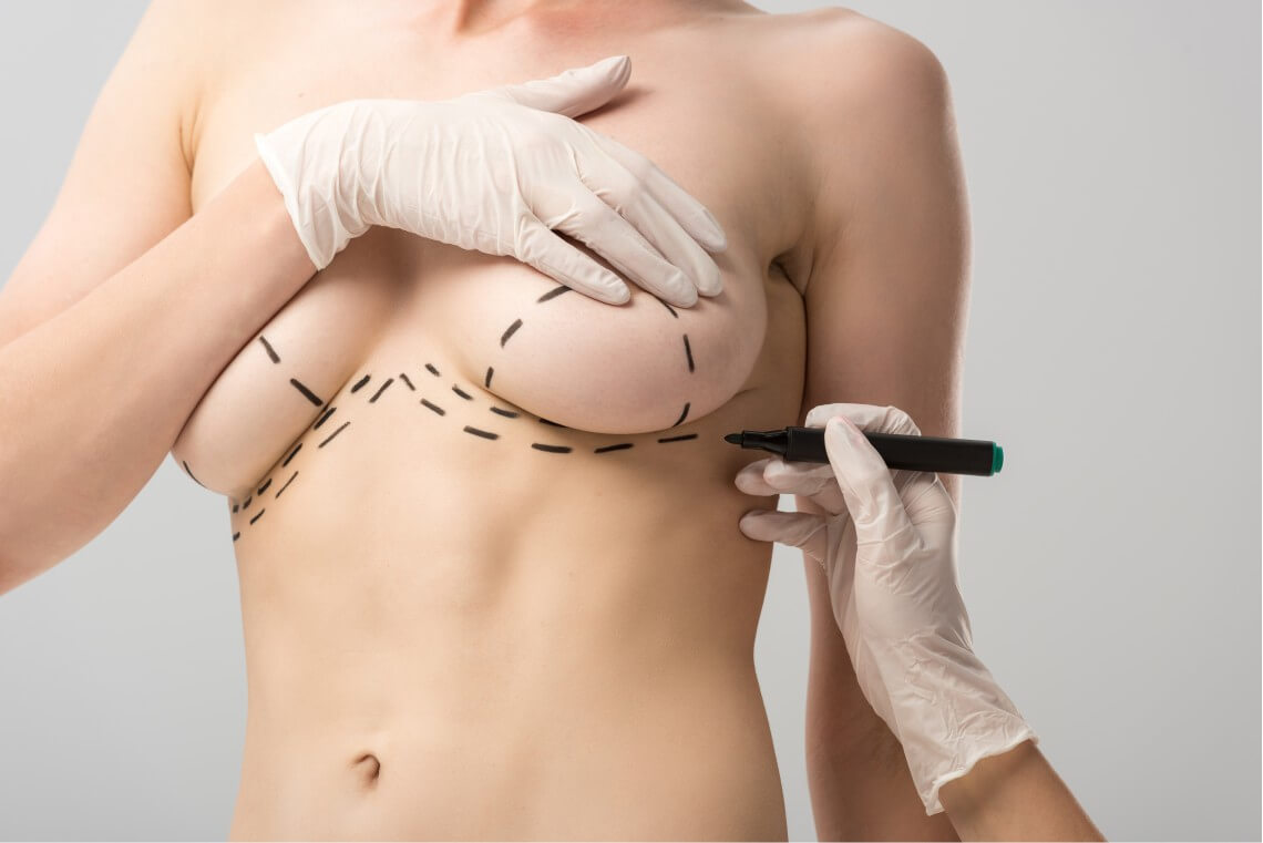 Mamoplastia com alça muscular e sutiã interno – Dra. Lara Reis